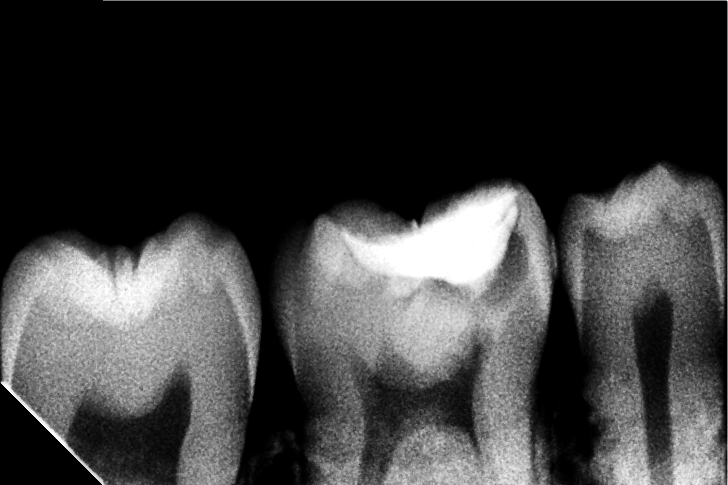 Before Treatment